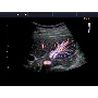 Accuvix A30 - vese color Doppler képe