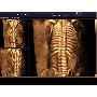 Magzati gerincoszlop 3D képe - Accuvix A30
