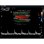 Carotis Color Doppler képe 2 - MySono U6
